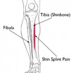 shin-splints