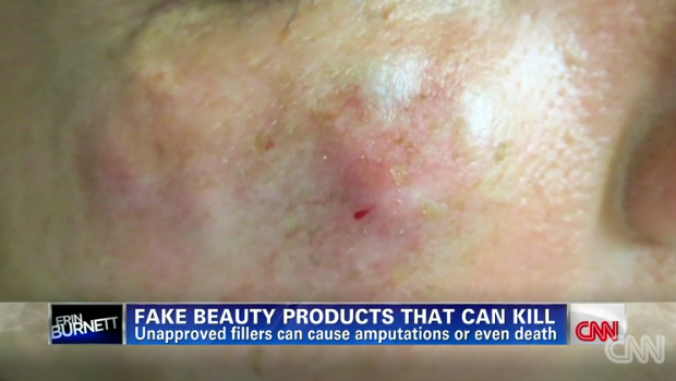 face-implants